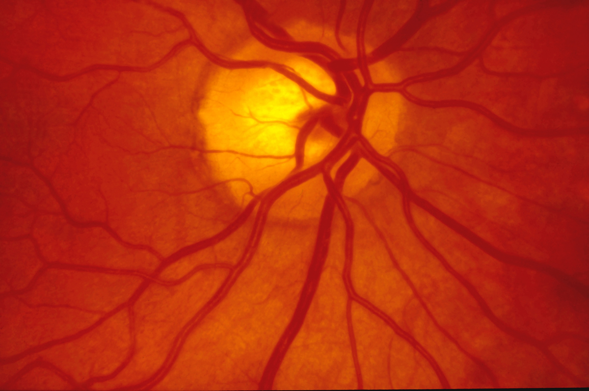 Retina Damar Tıkanıklığı